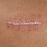 litteken behandeling