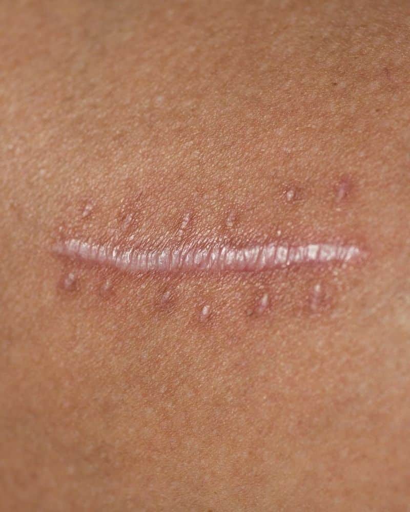 litteken behandeling